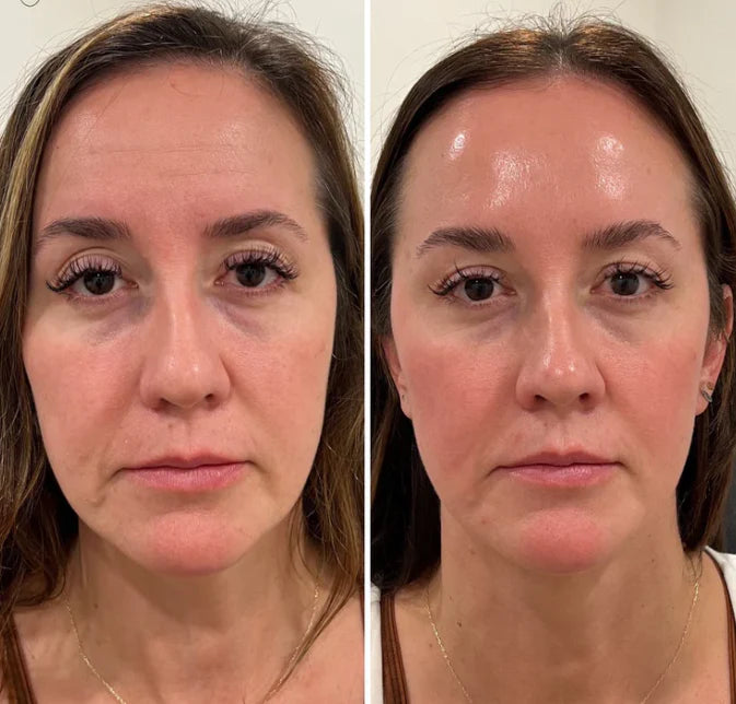 GlowLift - Masajeador Facial Antiarrugas - 3 en 1